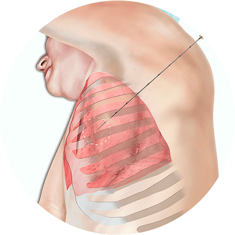 Biópsia pulmonar