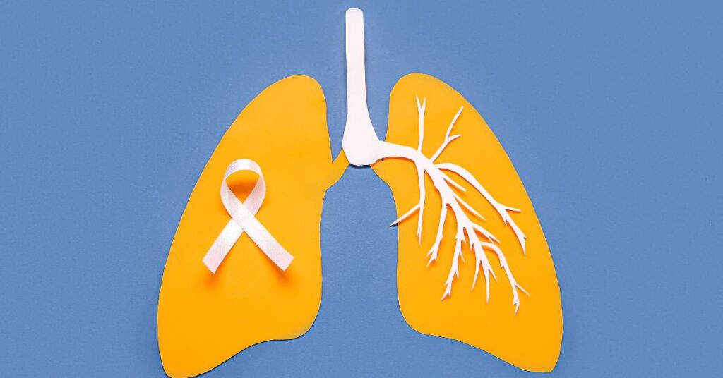 Recuperação Após a Cirurgia de Câncer de Pulmão: dicas para um retorno saudável 1 Recuperação Após a Cirurgia de Câncer de Pulmão - Dicas Para um Retorno Saudável